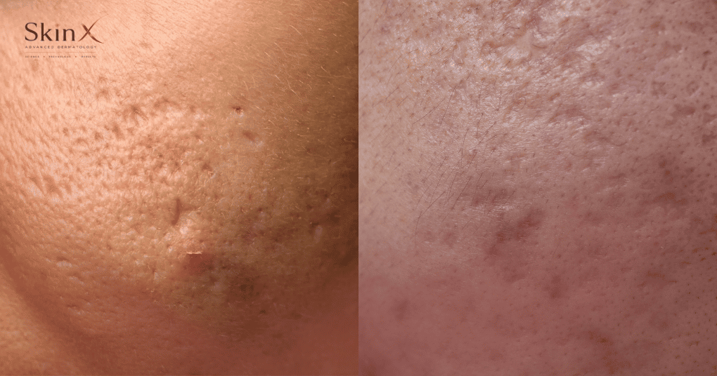 Điều trị sẹo rỗ bằng công nghệ Laser Fractional CO2